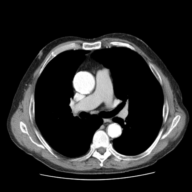 Autosomal dominant polycystic kidney disease (Radiopaedia 27851-28094 B 27).jpg
