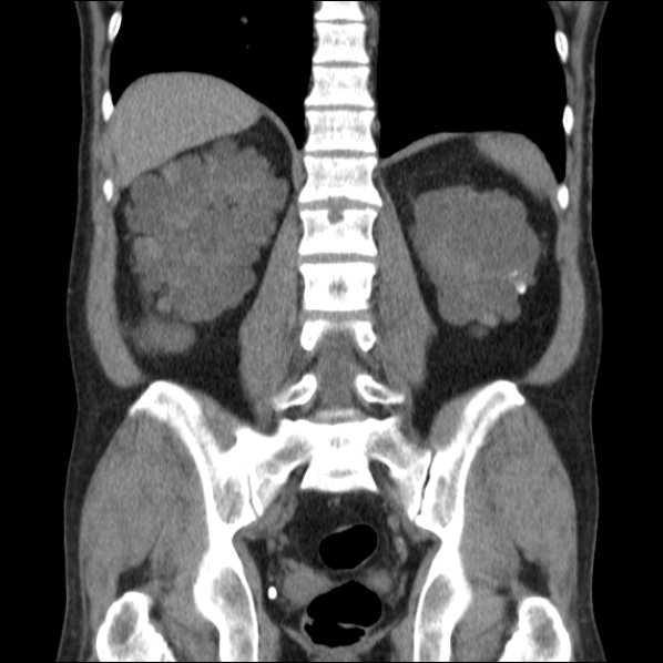 File:Autosomal dominant polycystic kidney disease (Radiopaedia 36539-38101 C 49).jpg