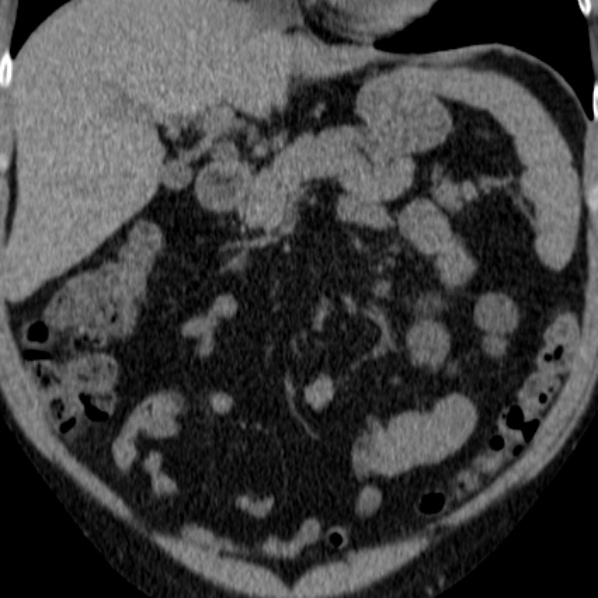 File:Autosomal dominant polycystic kidney disease (Radiopaedia 36539-38101 Coronal non-contrast 7).jpg