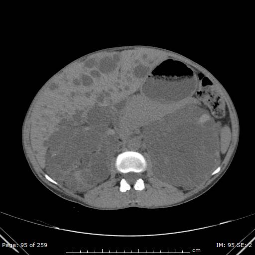 File:Autosomal dominant polycystic kidney disease (Radiopaedia 44122-47684 Axial 27).jpg