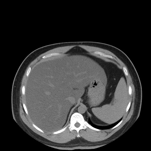 Autosomal dominant polycystic kidney disease (Radiopaedia 50259-55612 Axial non-contrast 21).jpg