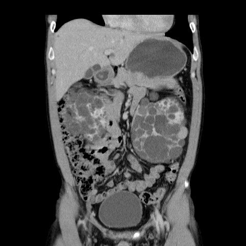 File:Autosomal dominant polycystic kidney disease (Radiopaedia 66349-75582 A 21).jpg