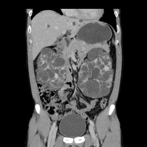 Autosomal dominant polycystic kidney disease (Radiopaedia 66349-75582 A 25).jpg