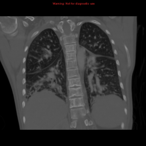 Avascular necrosis in sickle cell disease (Radiopaedia 17448-17152 Coronal bone window 89).jpg