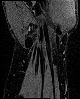 Avascular necrosis of the capitate (Radiopaedia 88317-104948 Coronal T1 vibe 72).jpg
