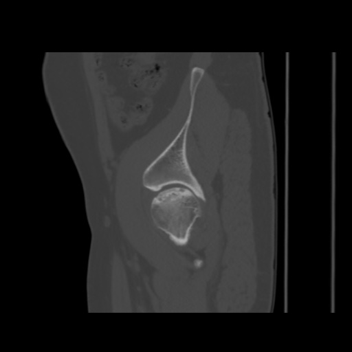 Avascular necrosis of the hip (Radiopaedia 61503-69467 B 13).jpg