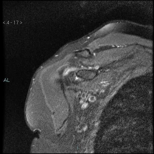 File:Avascular necrosis of the shoulder - Cruess stage I (Radiopaedia 77674-89886 Coronal PD fat sat 17).jpg