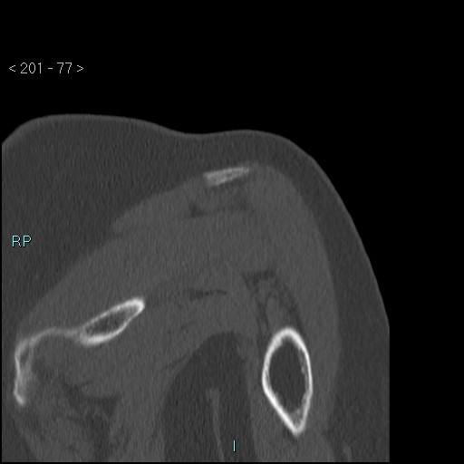 Avascular necrosis of the shoulder - Cruess stage I (Radiopaedia 77674-89887 Coronal bone window 76).jpg