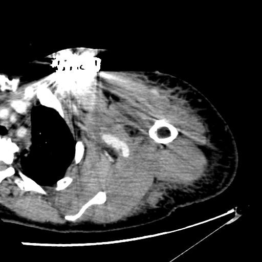 File:Axillary arterial pseudoaneurysm (Radiopaedia 24925-25195 A 10).jpg