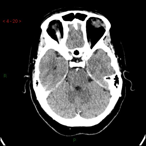 Azygos anterior cerebral artery (Radiopaedia 51987-57833 A 20).jpg
