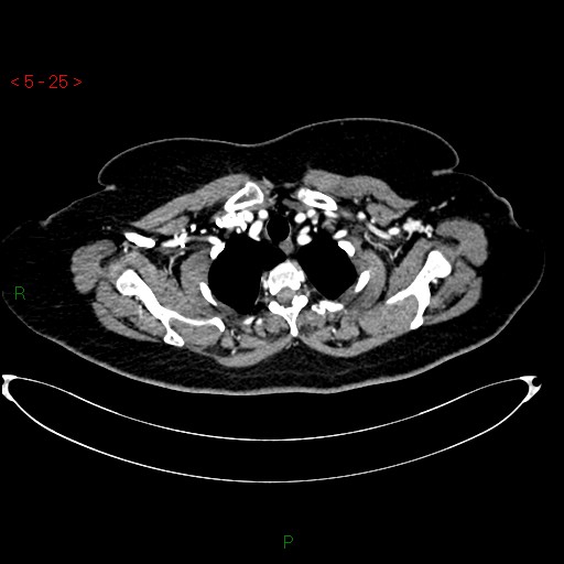 File:Azygos fissure and lobe (Radiopaedia 47620-52278 A 11).jpg