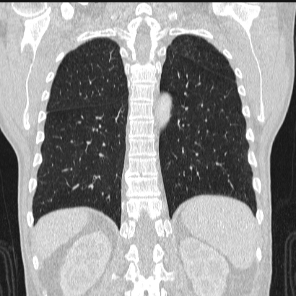 Azygos lobe (Radiopaedia 38259-40275 Coronal lung window 60).jpg
