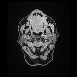 Balo concentric sclerosis (Radiopaedia 53875-59982 Axial LAVA C+ 1).jpg