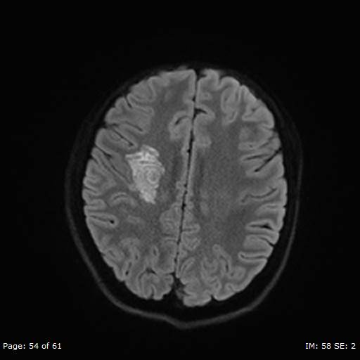 Balo concentric sclerosis (Radiopaedia 61637-69636 Axial DWI 54).jpg
