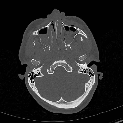 Base of skull fracture with bilateral Le Fort fractures (Radiopaedia 47094-51638 Axial bone window 24).jpg
