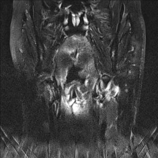 File:Base of tongue squamous cell carcinoma (Radiopaedia 31174-31884 Coronal T2 fat sat 11).jpg