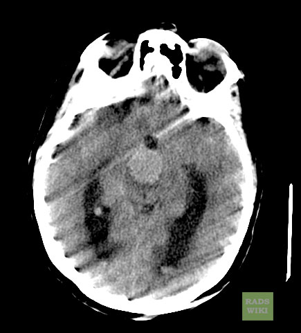 File:Basilar artery aneurysm (Radiopaedia 11533-11896 Axial 1).jpg