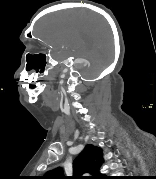 Basilar artery aneurysm (Radiopaedia 56261-62932 C 13).jpg