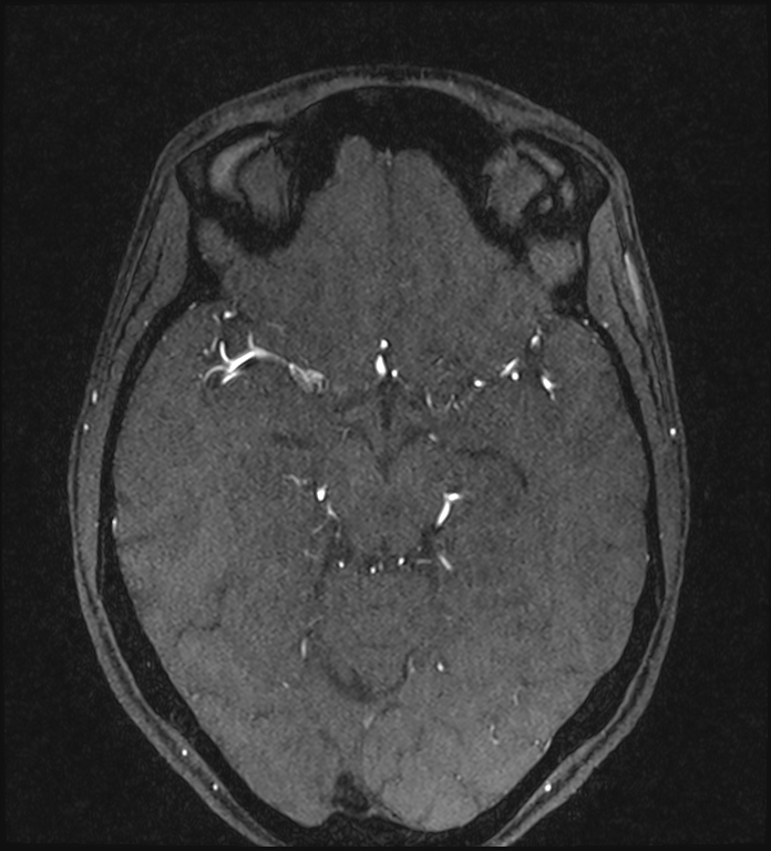 Basilar artery perforator aneurysm (Radiopaedia 82455-97733 Axial MRA 109).jpg