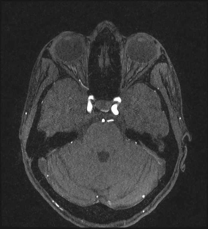 Basilar artery perforator aneurysm (Radiopaedia 82455-97733 Axial MRA 82).jpg