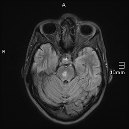 File:Basilar artery perforator aneurysm (Radiopaedia 82455-99523 Axial FLAIR 8).jpg