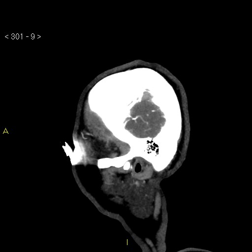 Basilar artery thrombosis (Radiopaedia 16260-15944 C 3).jpg