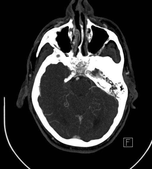 Basilar artery thrombosis (Radiopaedia 26986-27163 A 32).jpg