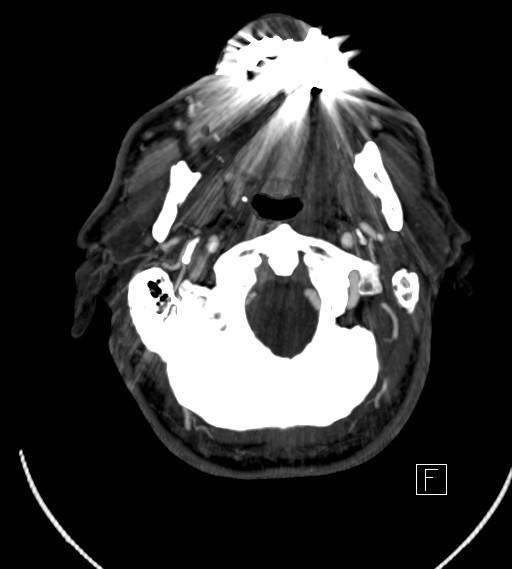 Basilar artery thrombosis (Radiopaedia 26986-27163 A 9).jpg