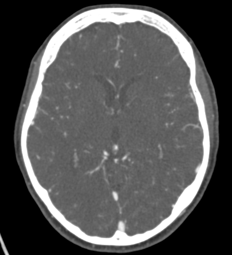 Basilar tip aneurysm with coiling (Radiopaedia 53912-60086 A 75).jpg