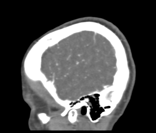 Basilar tip aneurysm with coiling (Radiopaedia 53912-60086 C 119).jpg