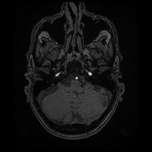 Basilar top and left middle cerebral artery aneurysm (Radiopaedia 61965-70031 Axial MRA 26).jpg