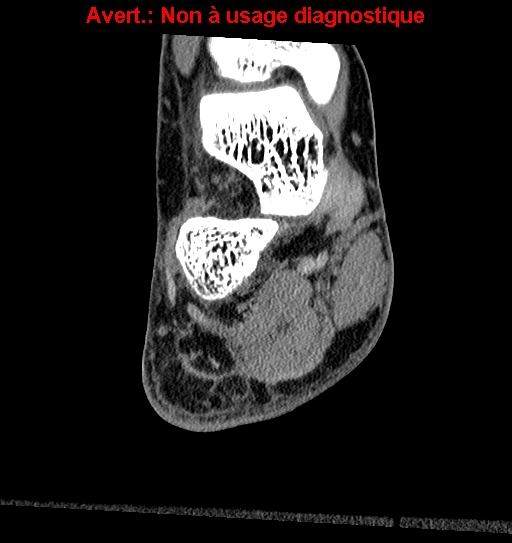 Baxter neuropathy (Radiopaedia 25988-26125 Coronal non-contrast 13).jpg