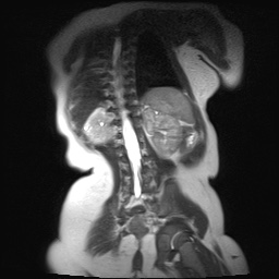File:Beckwith-Wiedeman syndrome with bilateral Wilms tumors (Radiopaedia 60850-69233 B 5).jpg