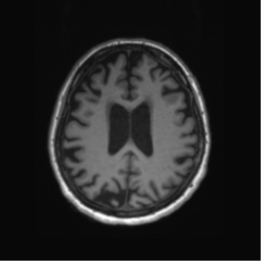 File:Behavioral variant frontotemporal dementia and late onset schizophrenia (Radiopaedia 52197-58083 Axial T1 31).png