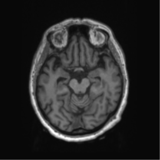 Behavioral variant frontotemporal dementia and late onset schizophrenia (Radiopaedia 52197-58083 Axial T1 66).png