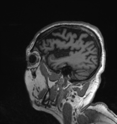Behavioral variant frontotemporal dementia and late onset schizophrenia (Radiopaedia 52197-58083 Sagittal T1 9).png