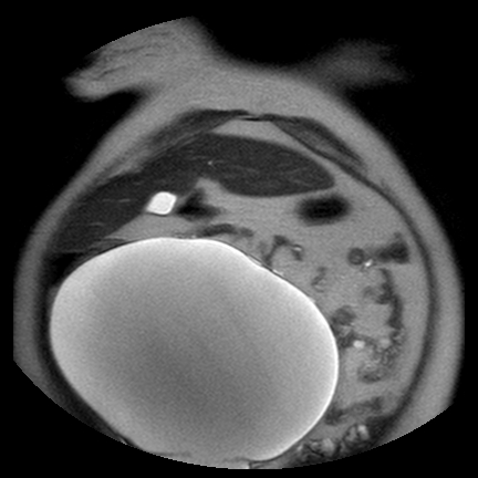 File:Benign seromucinous cystadenoma of the ovary (Radiopaedia 71065-81300 Coronal T2 10).jpg
