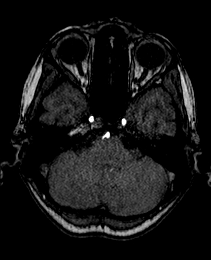 Berry aneurysm of the terminal internal carotid artery (Radiopaedia 88286-104918 Axial TOF 73).jpg