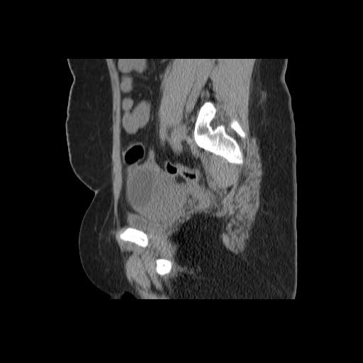 File:Bicornuate uterus- on MRI (Radiopaedia 49206-54296 A 15).jpg