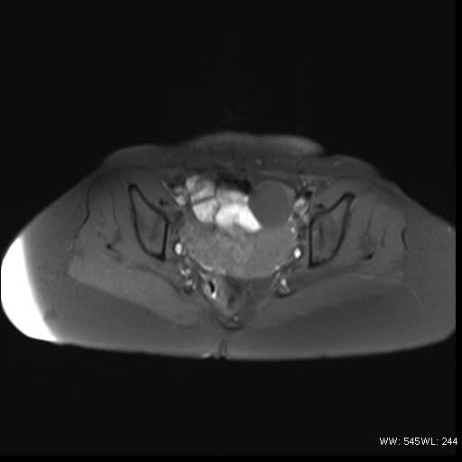 File:Bicornuate uterus- on MRI (Radiopaedia 49206-54297 Axial T1 fat sat 12).jpg