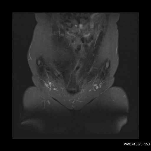 File:Bicornuate uterus- on MRI (Radiopaedia 49206-54297 Coronal STIR 1).jpg