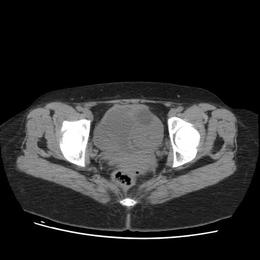 File:Bicornuate uterus (MRI) (Radiopaedia 49206-54296 Axial 1).jpg