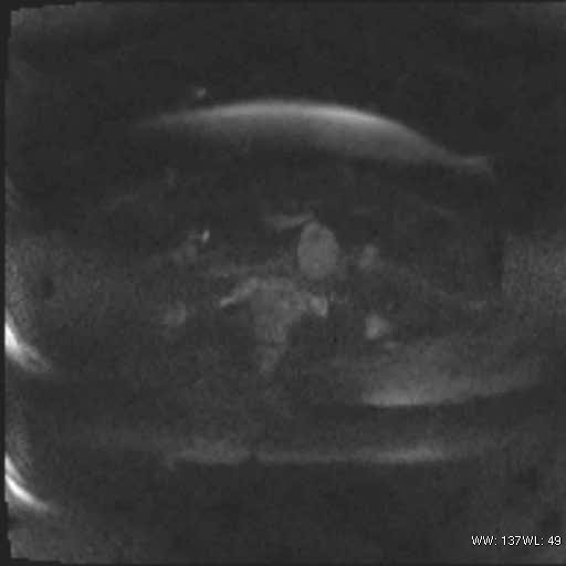 File:Bicornuate uterus (MRI) (Radiopaedia 49206-54297 Axial 101).jpg