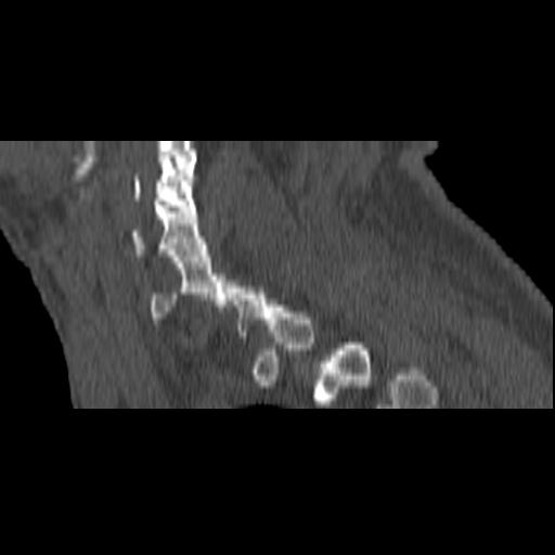 File:Bilateral C6-7 locked facet dislocation (Radiopaedia 28506-28748 Sagittal bone window 3).jpeg