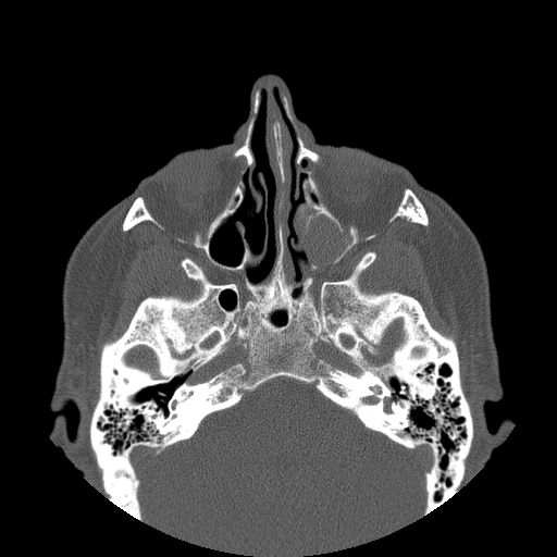 File:Bilateral Ectopic Infraorbital Nerves (Radiopaedia 49006-58325 Axial 7).jpg
