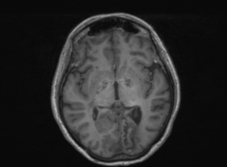 Bilateral PCA territory infarction - different ages (Radiopaedia 46200-51784 Axial T1 244).jpg