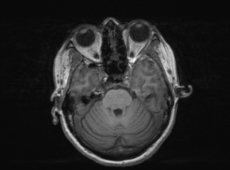 Bilateral PCA territory infarction - different ages (Radiopaedia 46200-51784 Axial T1 291).jpg