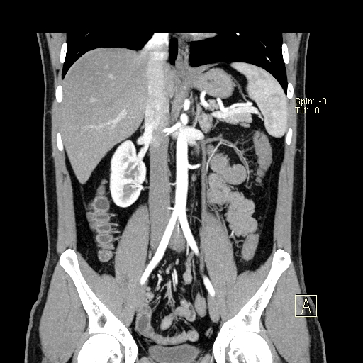 File:Bilateral accessory renal arteries with mild pelvi-ureteric junction (PUJ) obstruction (Radiopaedia 66357-75596 B 18).jpg