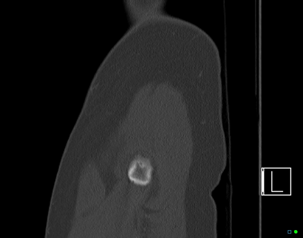 Bilateral acetabular fractures (Radiopaedia 79272-92308 Sagittal bone window 1).jpg