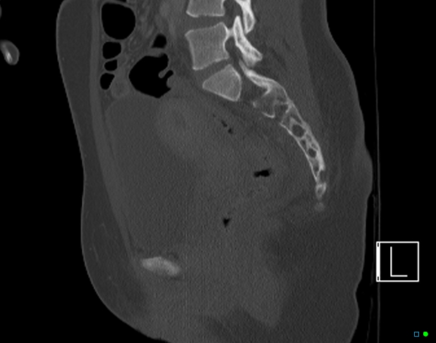 Bilateral acetabular fractures (Radiopaedia 79272-92308 Sagittal bone window 43).jpg
